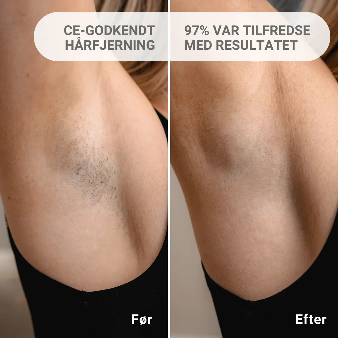 2x IPL Permanent hårfjerner Pakketilbud - Image 3