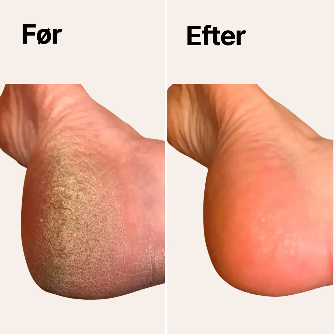 SoleCare Elektrisk Fjerner til Hård Hud - Image 4